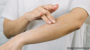 Rekomendasi Pilihan Obat Dermatitis Sesuai Kondisi Kulit